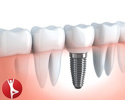 Slider image (3) Dental Solutions Centre for Implants and Laser Dentistry